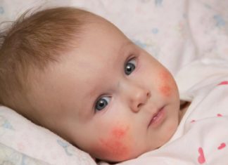 Allergieën Samen Zwanger - Allergieën