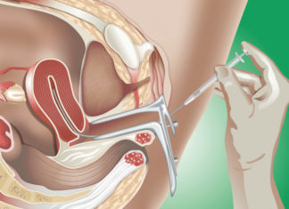 Intra-uteriene inseminatie Samen Zwanger - Intra-uteriene inseminatie