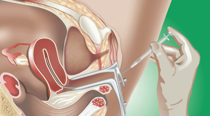 Intra-uteriene inseminatie Samen Zwanger - Intra-uteriene inseminatie