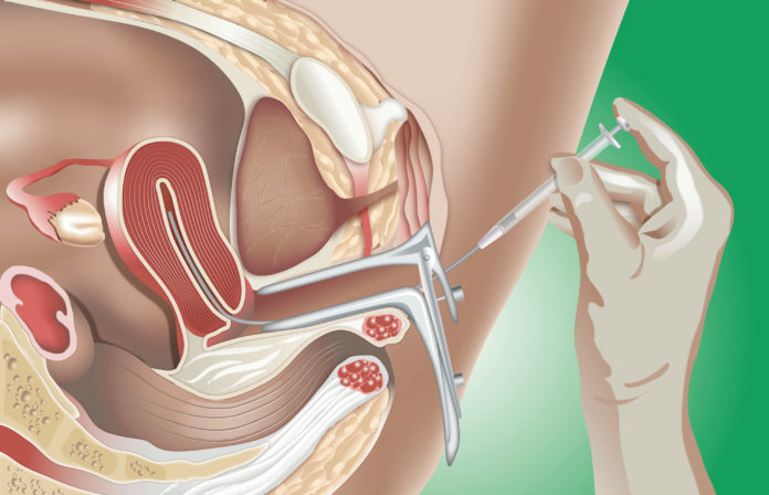 Samen Zwanger - Intra-uteriene inseminatie