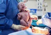 Keizersnede Samen Zwanger - Keizersnede