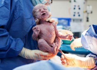 Keizersnede Samen Zwanger - Keizersnede