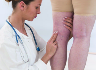 (Last van) Spataderen Samen Zwanger - Spataderen