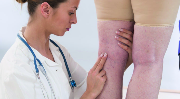 (Last van) Spataderen Samen Zwanger - Spataderen