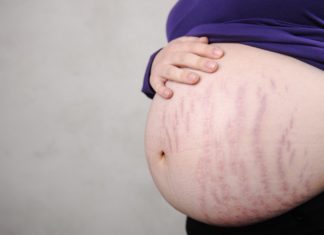 Striae Samen Zwanger - Striae