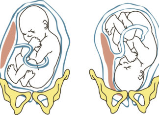 Stuitligging Samen Zwanger - Stuitligging