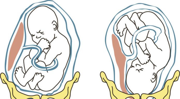 Stuitligging Samen Zwanger - Stuitligging