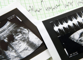 Advies Zorginstituut: NIPT niet in basisverzekering Samen Zwanger - Advies Zorginstituut NIPT niet in basisverzekering