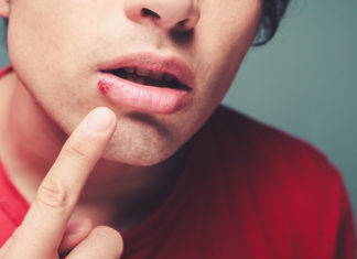 Koortslip: Schadelijk voor mijn baby? Samen Zwanger - Koortslip