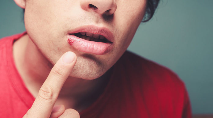 Koortslip: Schadelijk voor mijn baby? Samen Zwanger - Koortslip