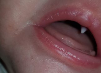 Een baby krijgt plotseling een vampiertandje Samen Zwanger - Een baby krijgt plotseling een vampiertandje