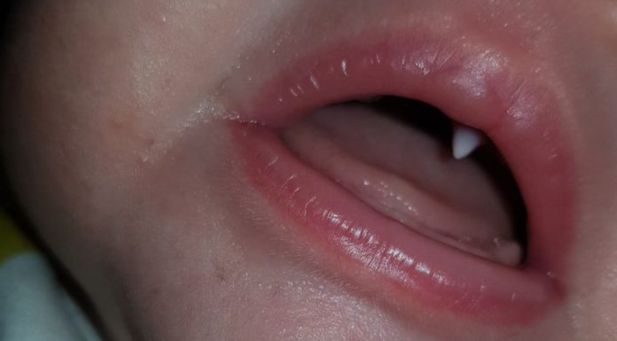 Een baby krijgt plotseling een vampiertandje Samen Zwanger - Een baby krijgt plotseling een vampiertandje